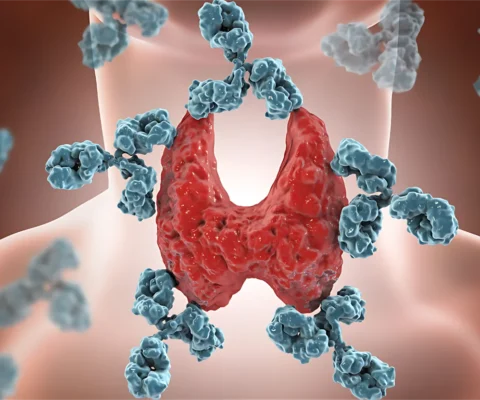 Tiroiditis de Hashimoto: Conoce la Enfermedad Autoinmune